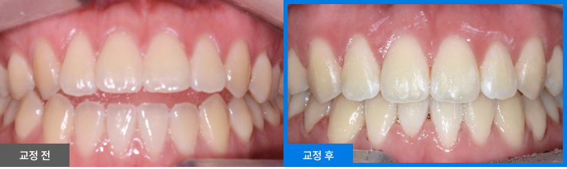 스케일링