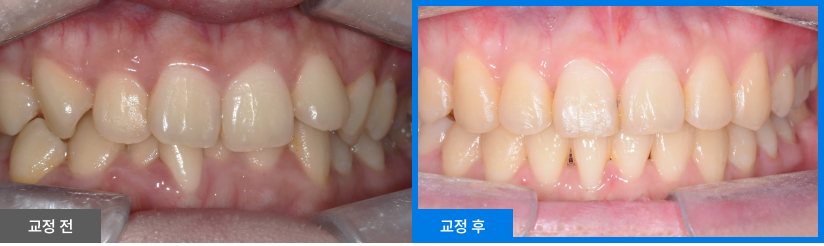 스케일링