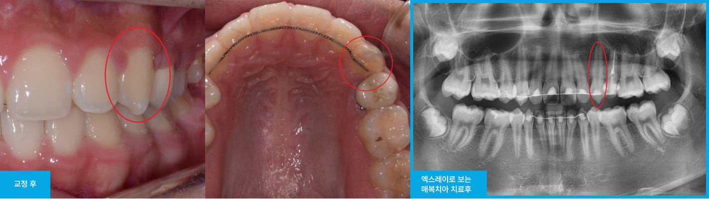 스케일링