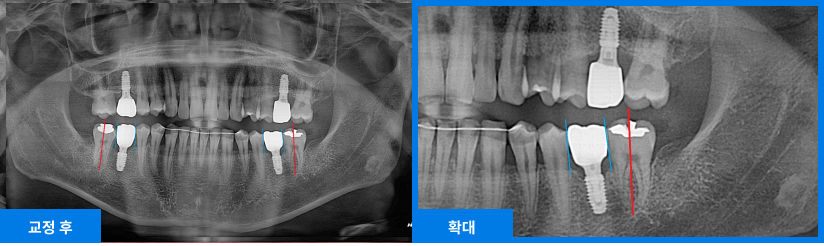 스케일링