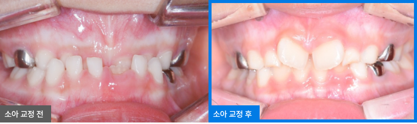 소아교정