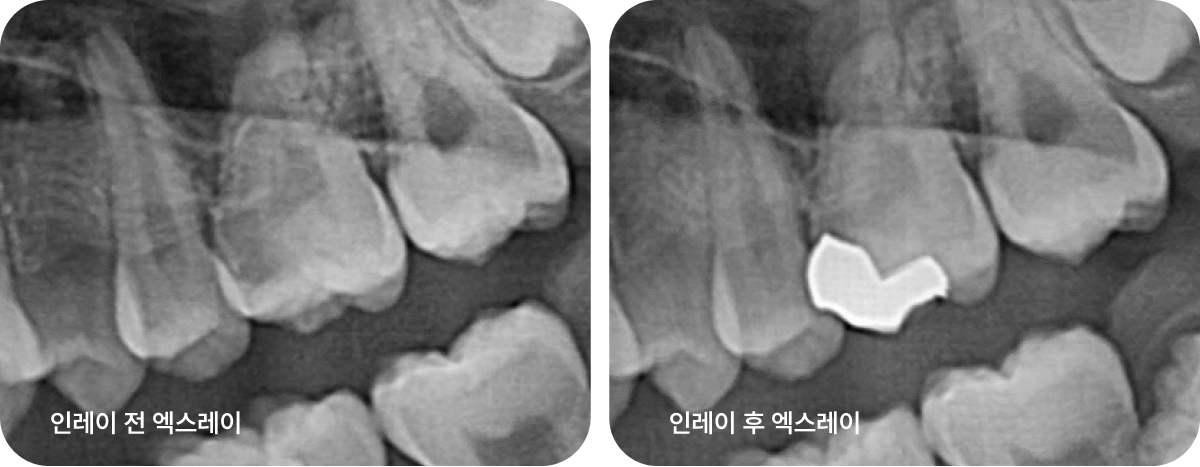 레진 치료 전 후 이미지